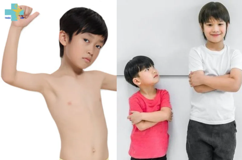 còi xương và suy dinh dưỡng ở trẻ