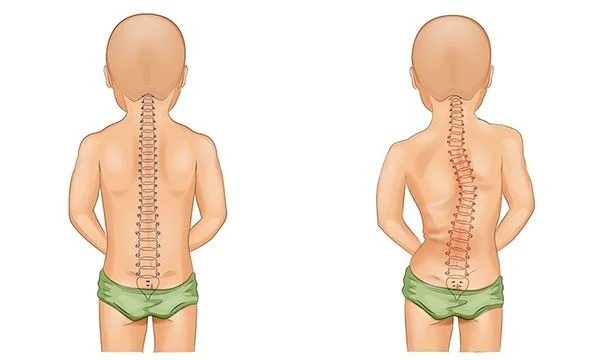 Xương bị biến dạng